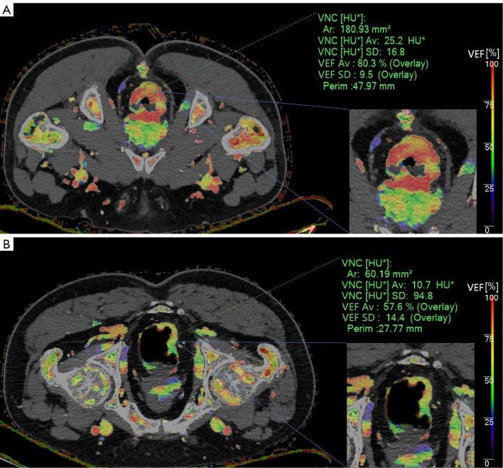 https://cdn.ncbi.nlm.nih.gov/pmc/blobs/6c91/10784072/631729928226/qims-14-01-618-f5.jpg