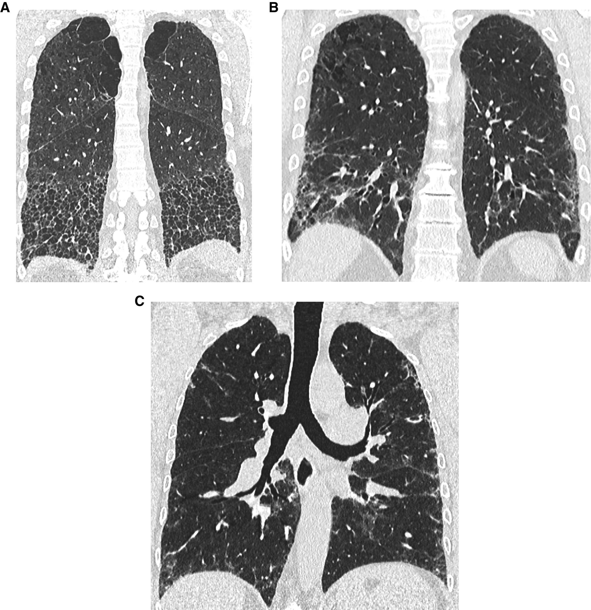 https://cdn.ncbi.nlm.nih.gov/pmc/blobs/6c94/9851481/3eb9c148255f/rccm.202202-0399STf8.jpg