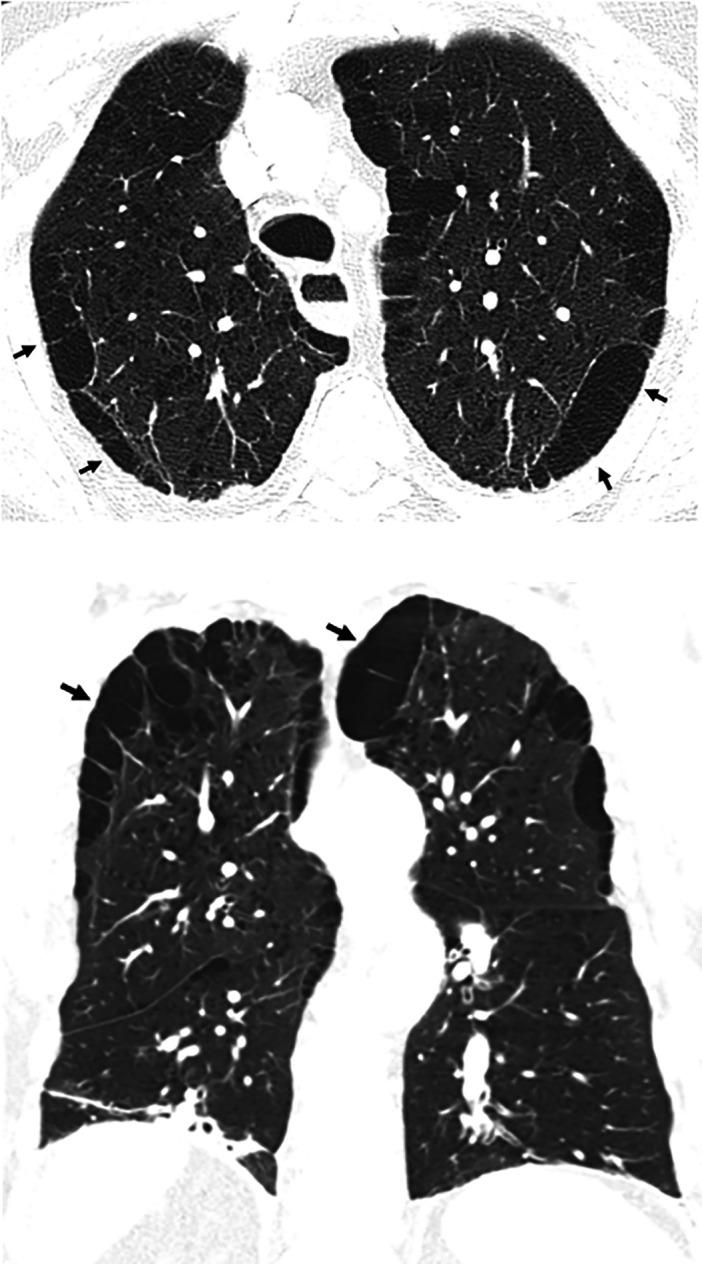 https://cdn.ncbi.nlm.nih.gov/pmc/blobs/6c94/9851481/452a7e01909f/rccm.202202-0399STf3.jpg