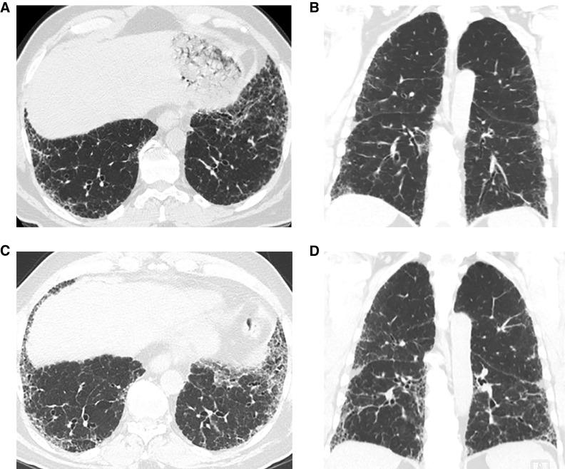 https://cdn.ncbi.nlm.nih.gov/pmc/blobs/6c94/9851481/5f2668526436/rccm.202202-0399STf13.jpg
