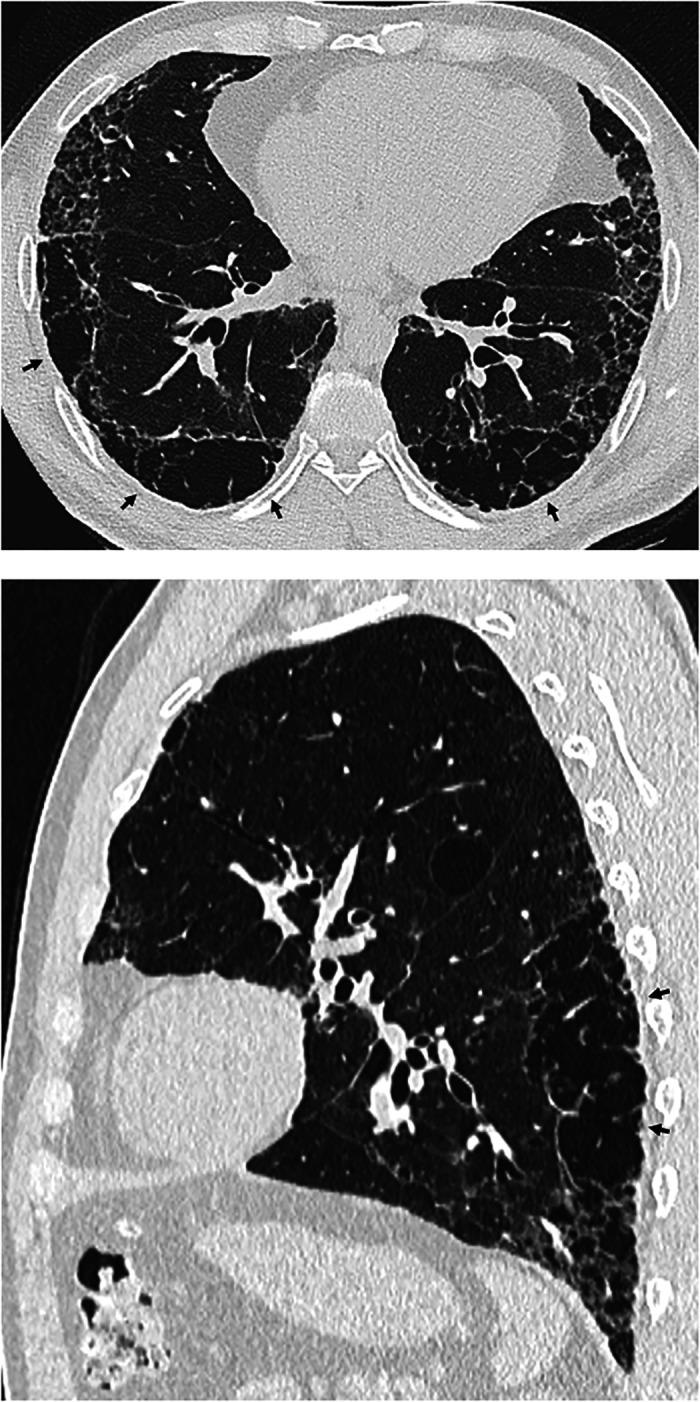 https://cdn.ncbi.nlm.nih.gov/pmc/blobs/6c94/9851481/79e1254d219f/rccm.202202-0399STf4.jpg