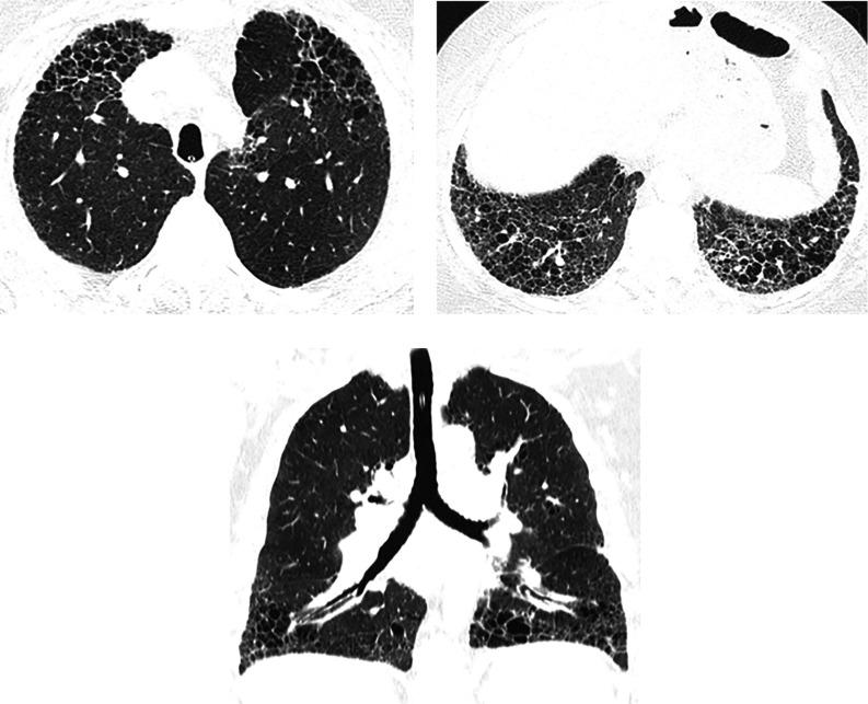 https://cdn.ncbi.nlm.nih.gov/pmc/blobs/6c94/9851481/a0fffaf57c22/rccm.202202-0399STf6.jpg