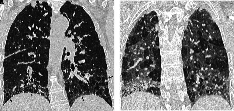 https://cdn.ncbi.nlm.nih.gov/pmc/blobs/6c94/9851481/a923c7c60e39/rccm.202202-0399STf5.jpg