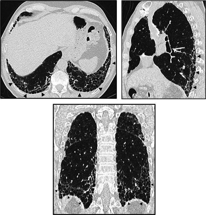 https://cdn.ncbi.nlm.nih.gov/pmc/blobs/6c94/9851481/bbcf47d2dc3f/rccm.202202-0399STf2.jpg