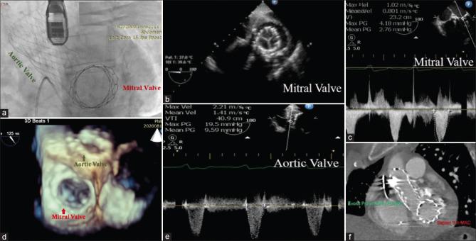 https://cdn.ncbi.nlm.nih.gov/pmc/blobs/6ce1/9997457/75aebcb3999f/ACA-26-78-g002.jpg