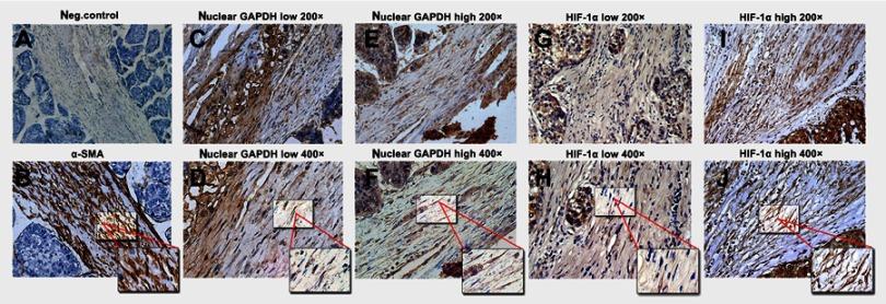 https://cdn.ncbi.nlm.nih.gov/pmc/blobs/6cf5/6553950/7b3228d1059c/CMAR-11-4947-g0003.jpg