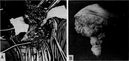 https://cdn.ncbi.nlm.nih.gov/pmc/blobs/6cfb/1802230/4f6f7a248e69/annsurg01418-0200-a.jpg