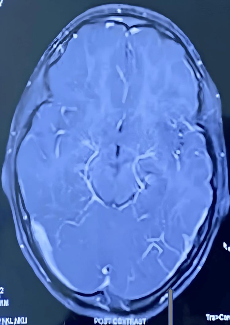 https://cdn.ncbi.nlm.nih.gov/pmc/blobs/6d19/10915452/592be2e07dd7/cureus-0016-00000053590-i02.jpg
