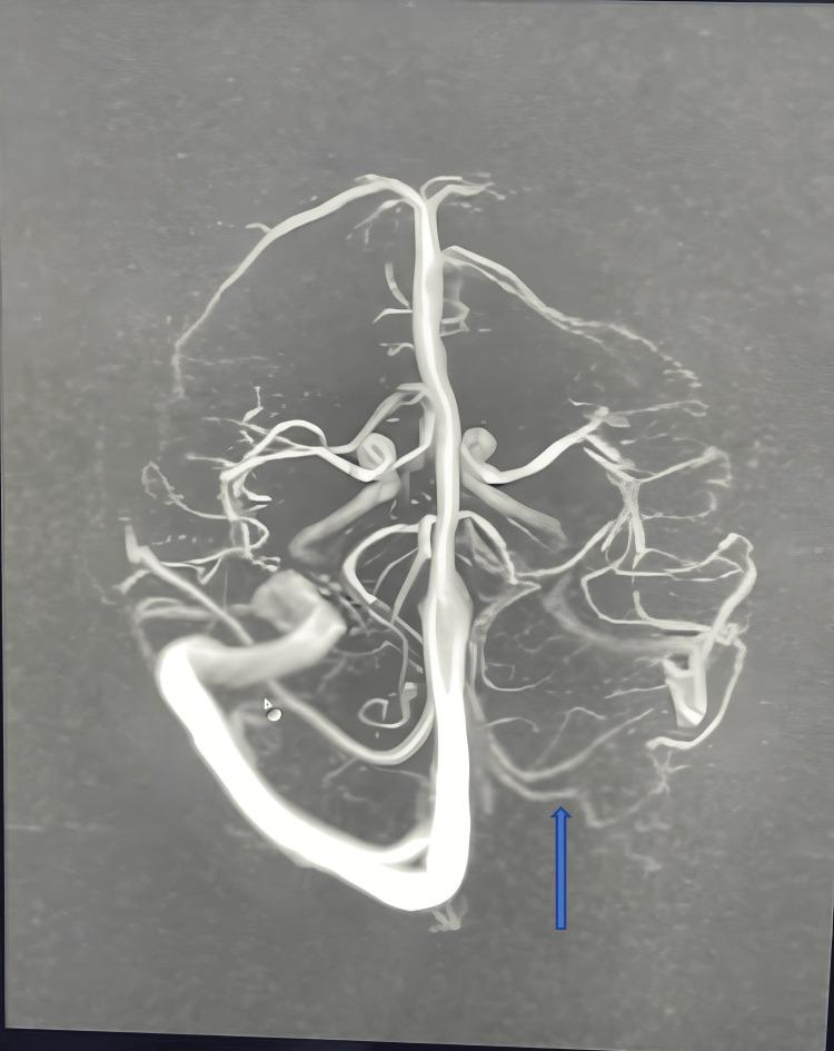 https://cdn.ncbi.nlm.nih.gov/pmc/blobs/6d19/10915452/9f36e86499c4/cureus-0016-00000053590-i03.jpg