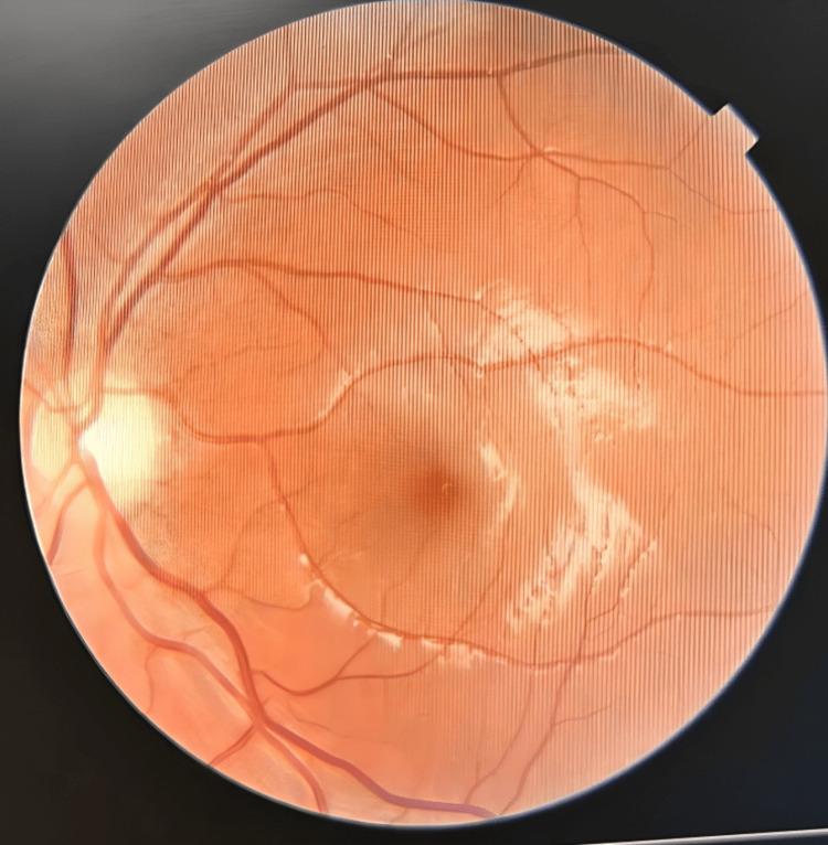 https://cdn.ncbi.nlm.nih.gov/pmc/blobs/6d19/10915452/b8212ea9470b/cureus-0016-00000053590-i01.jpg