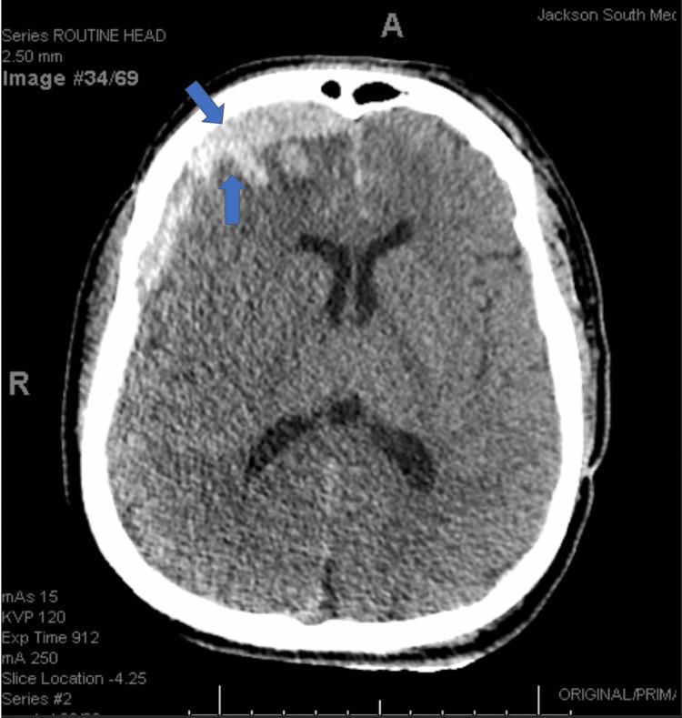 https://cdn.ncbi.nlm.nih.gov/pmc/blobs/6d27/9236628/32e27b9dc3ea/cureus-0014-00000025336-i01.jpg