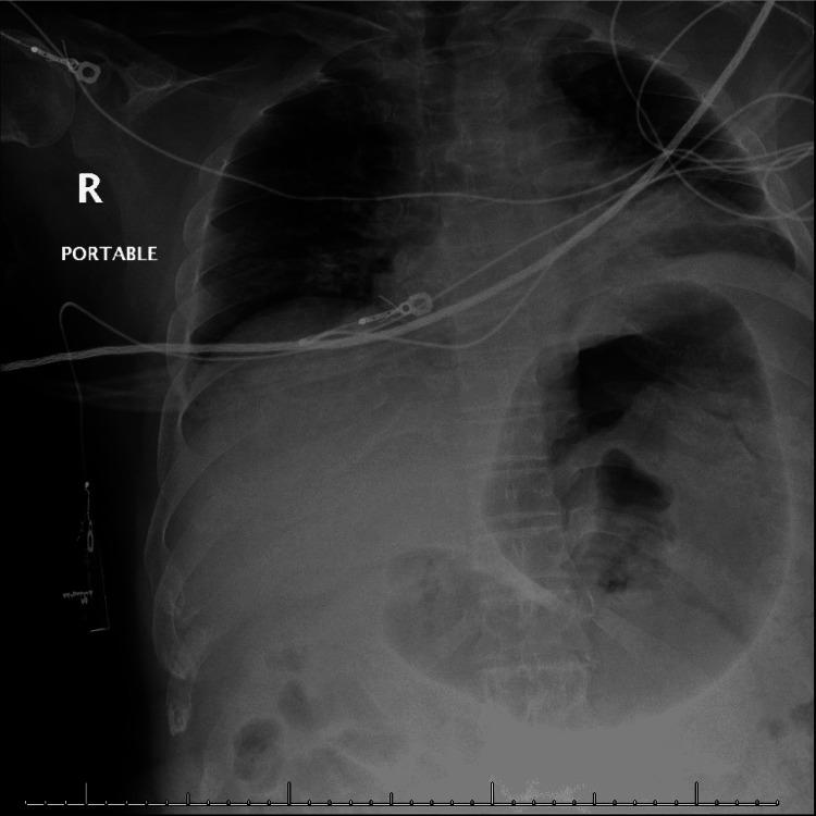 https://cdn.ncbi.nlm.nih.gov/pmc/blobs/6d27/9236628/b612d464f0ca/cureus-0014-00000025336-i02.jpg