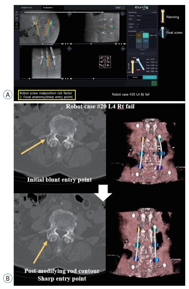 https://cdn.ncbi.nlm.nih.gov/pmc/blobs/6d33/10788558/1cf9656c716c/jkns-2023-0128f9.jpg