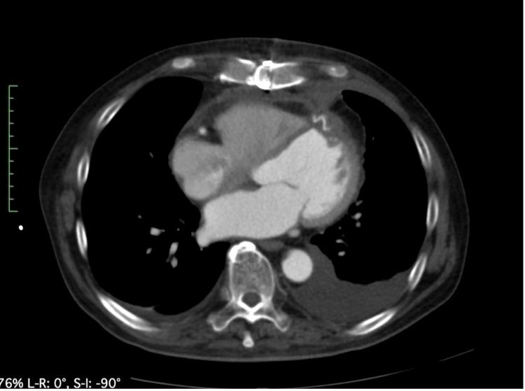 https://cdn.ncbi.nlm.nih.gov/pmc/blobs/6d35/11570913/1345b325316d/cureus-0016-00000071832-i07.jpg