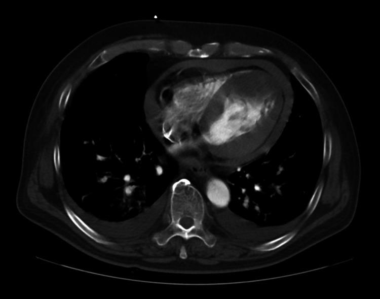https://cdn.ncbi.nlm.nih.gov/pmc/blobs/6d35/11570913/32c30a0f4076/cureus-0016-00000071832-i01.jpg