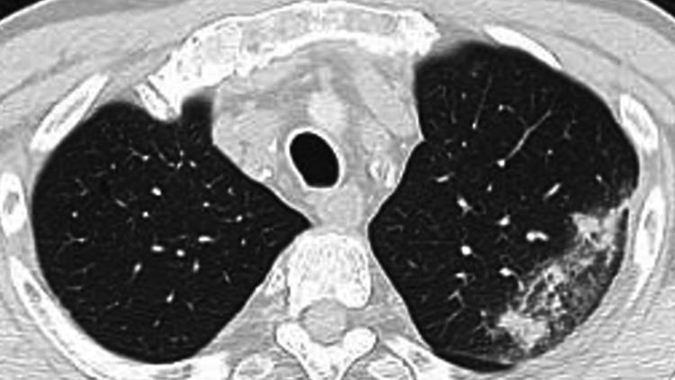 https://cdn.ncbi.nlm.nih.gov/pmc/blobs/6d50/8993129/05154856d213/cureus-0014-00000023001-i02.jpg