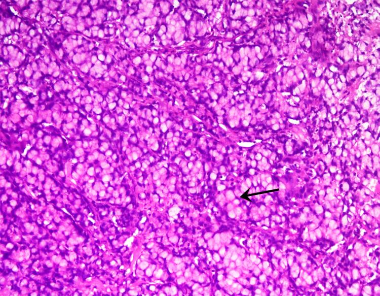 https://cdn.ncbi.nlm.nih.gov/pmc/blobs/6d6a/8920813/6d65920fa4e4/cureus-0014-00000022139-i04.jpg