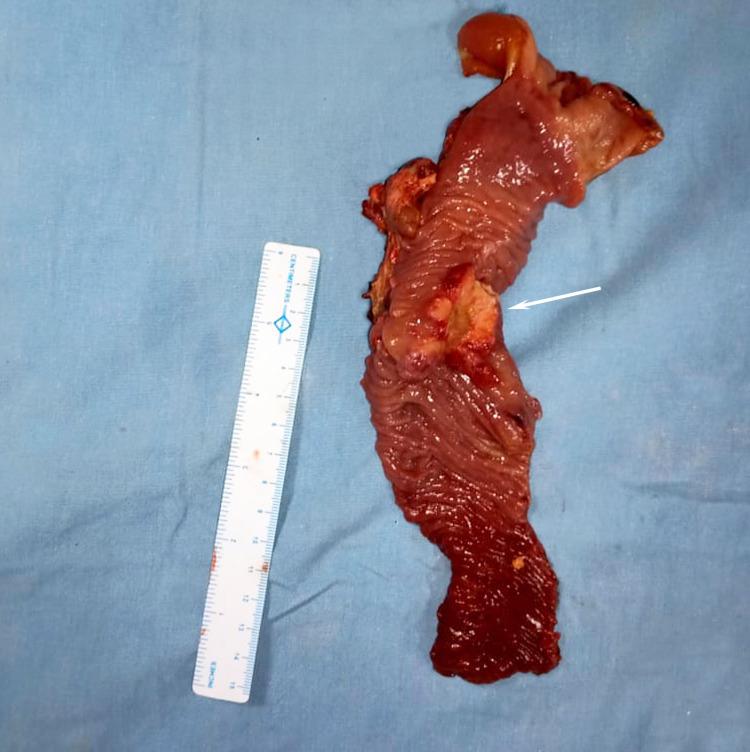 https://cdn.ncbi.nlm.nih.gov/pmc/blobs/6d6a/8920813/e925addd8035/cureus-0014-00000022139-i03.jpg