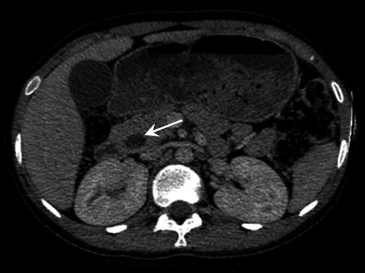 https://cdn.ncbi.nlm.nih.gov/pmc/blobs/6d6a/8920813/fa2025a0350c/cureus-0014-00000022139-i01.jpg