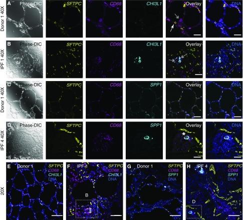 https://cdn.ncbi.nlm.nih.gov/pmc/blobs/6d79/6580683/7f2fccdab420/rccm.201712-2410OC_f7.jpg