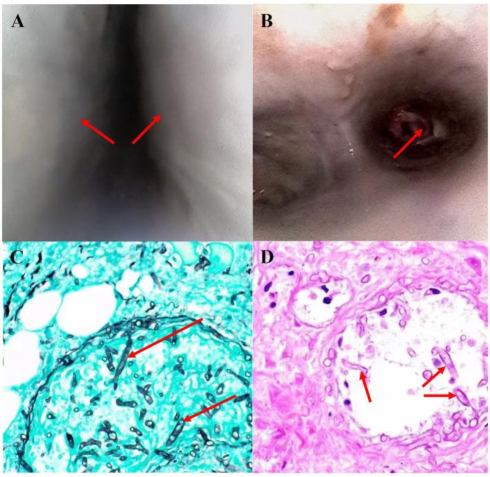 https://cdn.ncbi.nlm.nih.gov/pmc/blobs/6d81/11703827/7e8761e2a95e/fmed-11-1491489-g002.jpg