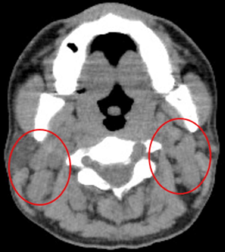 https://cdn.ncbi.nlm.nih.gov/pmc/blobs/6d96/10909682/7855fa0ee28e/cureus-0016-00000053472-i01.jpg