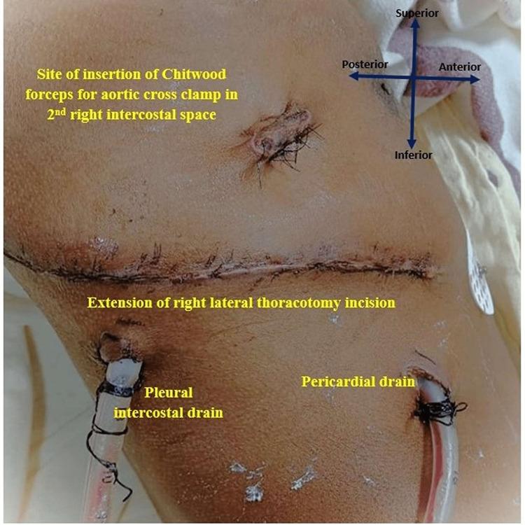https://cdn.ncbi.nlm.nih.gov/pmc/blobs/6d97/9949747/ae632b0690f7/cureus-0015-00000034138-i01.jpg