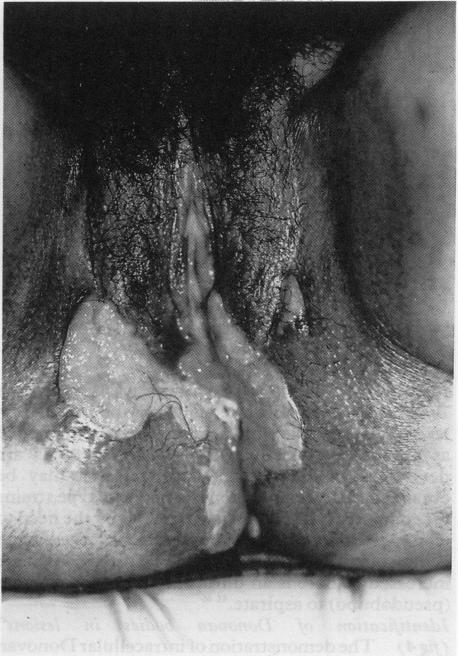 https://cdn.ncbi.nlm.nih.gov/pmc/blobs/6dbb/1194766/299ca9762352/genitmed00042-0007-b.jpg
