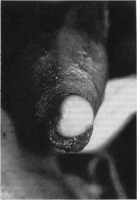 https://cdn.ncbi.nlm.nih.gov/pmc/blobs/6dbb/1194766/cd5e2bbeb145/genitmed00042-0007-a.jpg