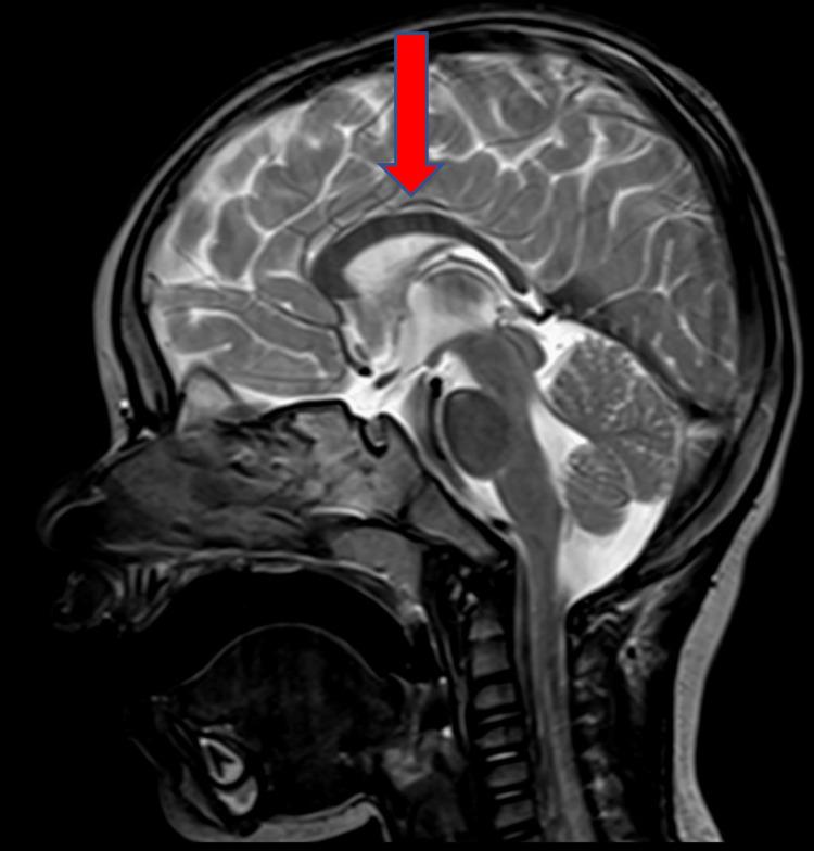 https://cdn.ncbi.nlm.nih.gov/pmc/blobs/6e35/10507423/3f0351bed6ab/cureus-0015-00000043781-i01.jpg