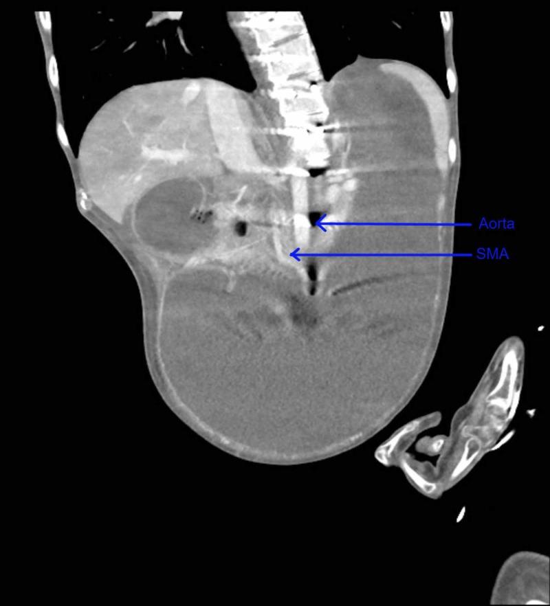 https://cdn.ncbi.nlm.nih.gov/pmc/blobs/6e98/6609291/5b6dc7ebdfb6/cureus-0011-00000004609-i02.jpg