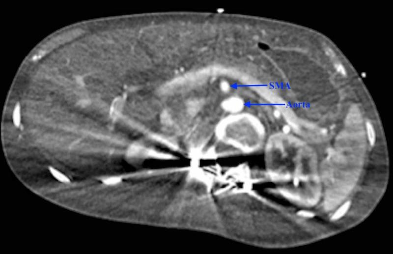 https://cdn.ncbi.nlm.nih.gov/pmc/blobs/6e98/6609291/b324a481cc69/cureus-0011-00000004609-i04.jpg