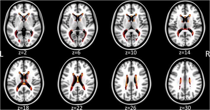 https://cdn.ncbi.nlm.nih.gov/pmc/blobs/6e9f/9671938/9351cd5c1d9f/fneur-13-982964-g0002.jpg