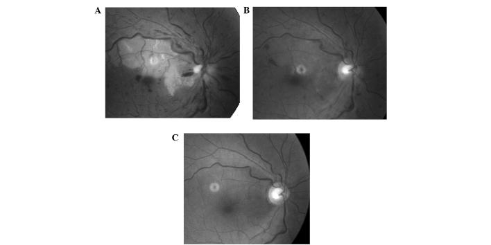 https://cdn.ncbi.nlm.nih.gov/pmc/blobs/6ebb/3964932/94571840b6c9/ETM-07-04-0995-g01.jpg