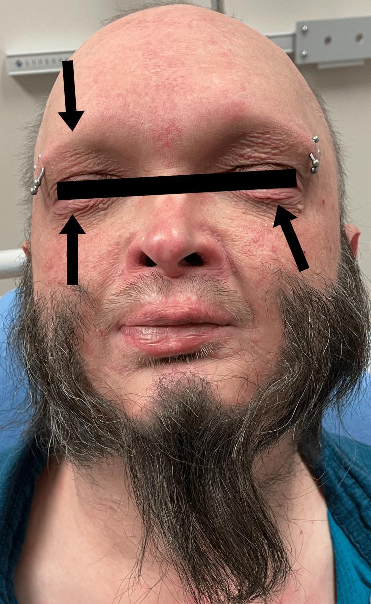 https://cdn.ncbi.nlm.nih.gov/pmc/blobs/6f48/10344640/2c87bc3f154a/cureus-0015-00000040383-i04.jpg