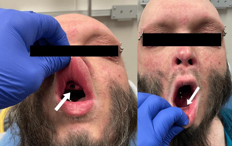 https://cdn.ncbi.nlm.nih.gov/pmc/blobs/6f48/10344640/7c58e3ae7cd6/cureus-0015-00000040383-i05.jpg