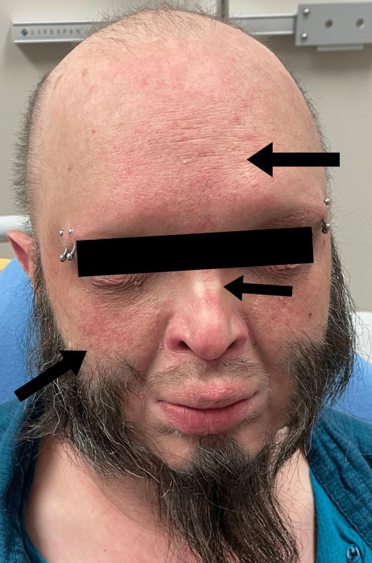 https://cdn.ncbi.nlm.nih.gov/pmc/blobs/6f48/10344640/b1d61fde2060/cureus-0015-00000040383-i01.jpg