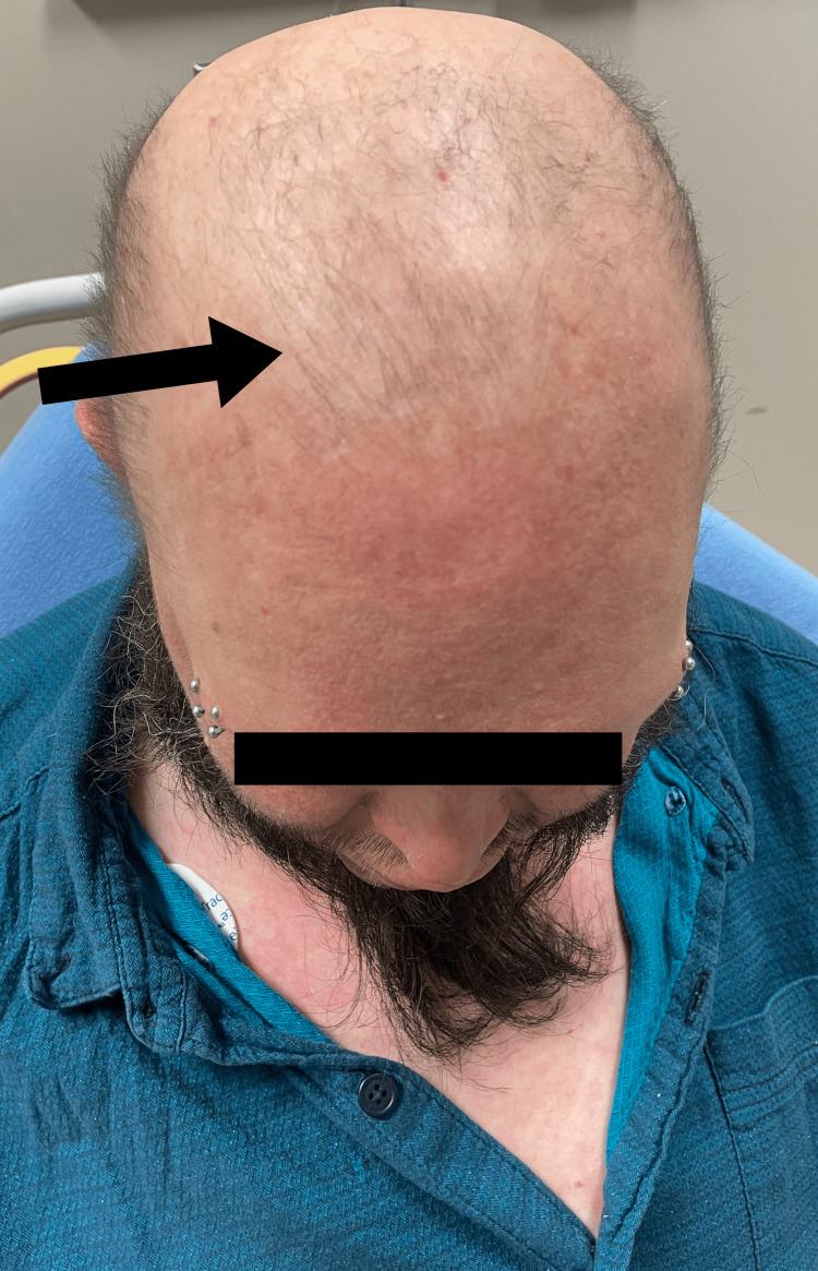 https://cdn.ncbi.nlm.nih.gov/pmc/blobs/6f48/10344640/c9880c59e00d/cureus-0015-00000040383-i03.jpg
