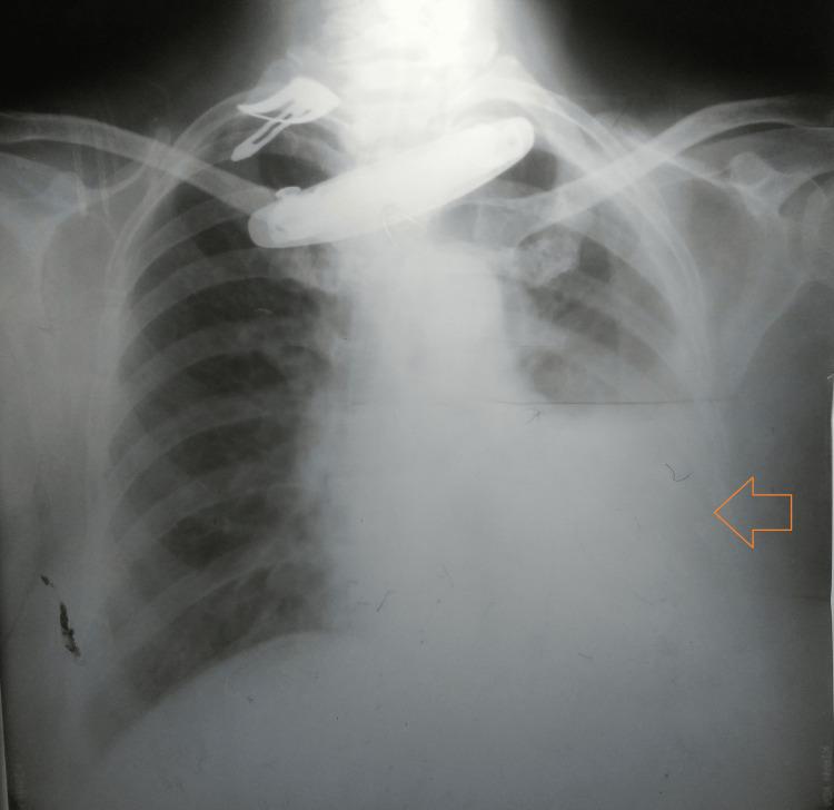https://cdn.ncbi.nlm.nih.gov/pmc/blobs/6f6b/11144592/3241942cfbe9/cureus-0016-00000059546-i01.jpg