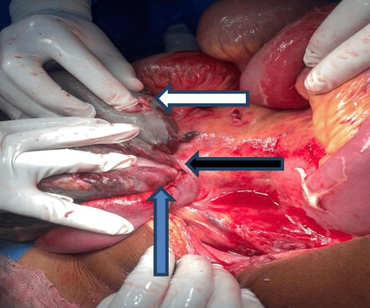 https://cdn.ncbi.nlm.nih.gov/pmc/blobs/6f8c/10967233/5350000735a9/cureus-0016-00000054936-i04.jpg