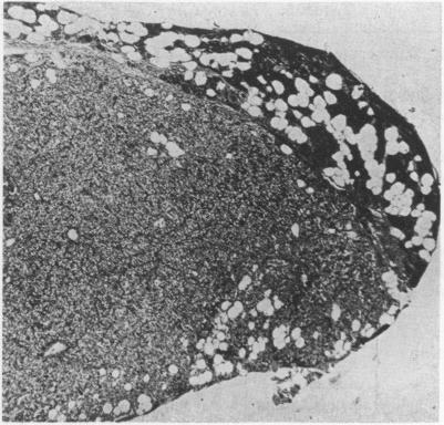 https://cdn.ncbi.nlm.nih.gov/pmc/blobs/6fa3/1450806/1751f9e5c69a/annsurg01227-0085-b.jpg