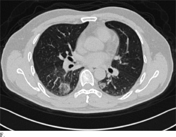 https://cdn.ncbi.nlm.nih.gov/pmc/blobs/6fbd/7233414/134964c5164b/radiol.2020200823.fig3f.jpg