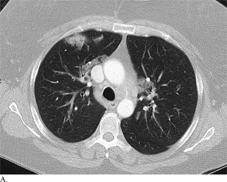 https://cdn.ncbi.nlm.nih.gov/pmc/blobs/6fbd/7233414/7a6c47878706/radiol.2020200823.fig3a.jpg