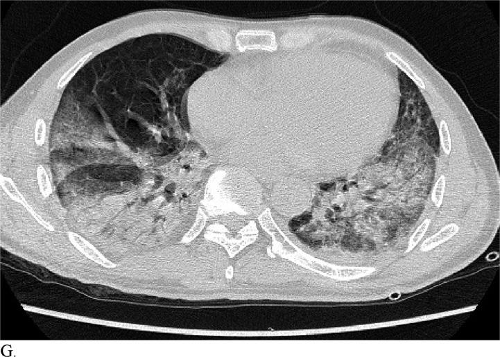https://cdn.ncbi.nlm.nih.gov/pmc/blobs/6fbd/7233414/8bb1b6b2f578/radiol.2020200823.fig3g.jpg