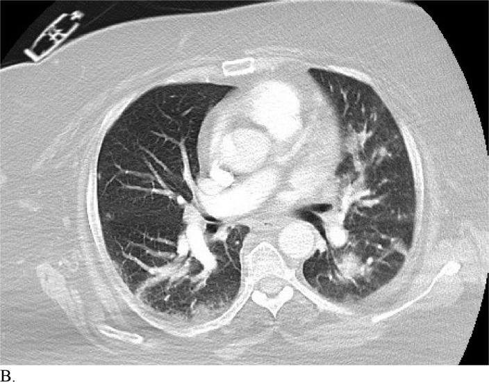 https://cdn.ncbi.nlm.nih.gov/pmc/blobs/6fbd/7233414/b08d4bce4b19/radiol.2020200823.fig3b.jpg
