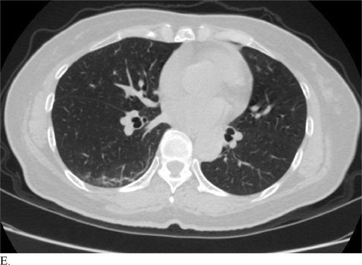 https://cdn.ncbi.nlm.nih.gov/pmc/blobs/6fbd/7233414/bddbcb28f84d/radiol.2020200823.fig3e.jpg