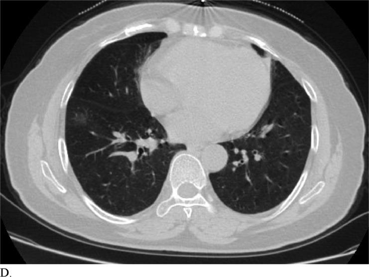 https://cdn.ncbi.nlm.nih.gov/pmc/blobs/6fbd/7233414/cdbbbe0dfde8/radiol.2020200823.fig3d.jpg