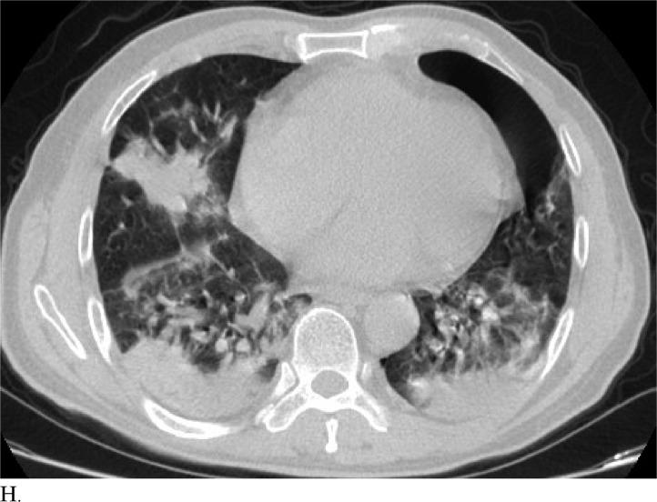 https://cdn.ncbi.nlm.nih.gov/pmc/blobs/6fbd/7233414/d9ce6c3ba4ac/radiol.2020200823.fig3h.jpg