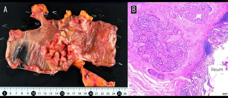 https://cdn.ncbi.nlm.nih.gov/pmc/blobs/7017/11334670/596ff91db842/amjcaserep-25-e944720-g005.jpg