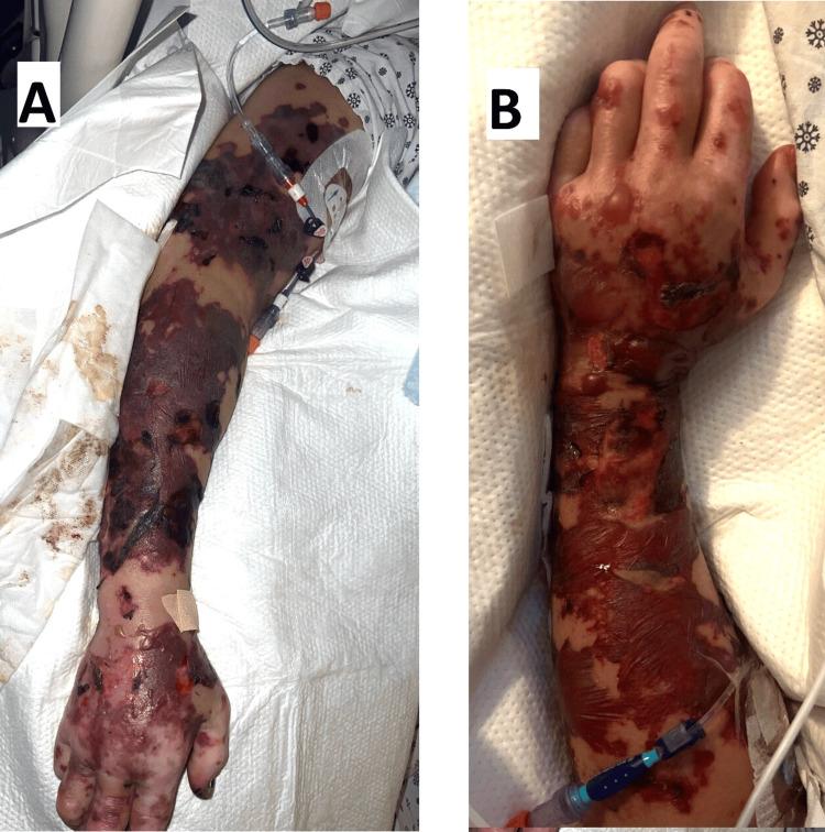 https://cdn.ncbi.nlm.nih.gov/pmc/blobs/704b/12173465/9728730c3b8b/cureus-0017-00000084350-i01.jpg